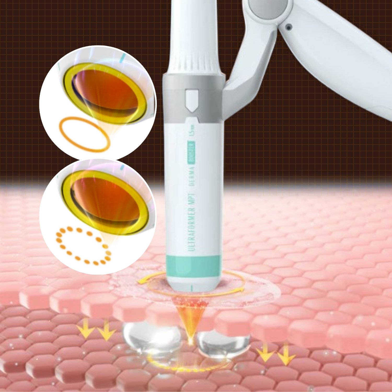 Công nghệ Ultra Booster Handpiece