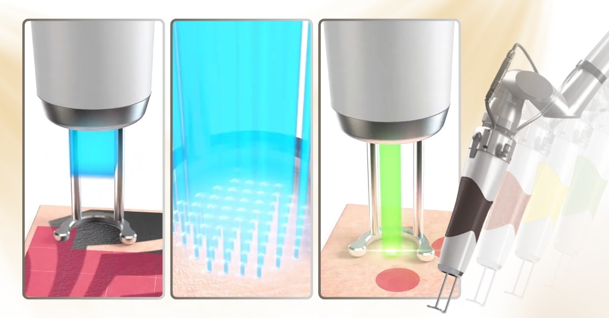 Đa bước sóng, đa chế độ phát xung (1)