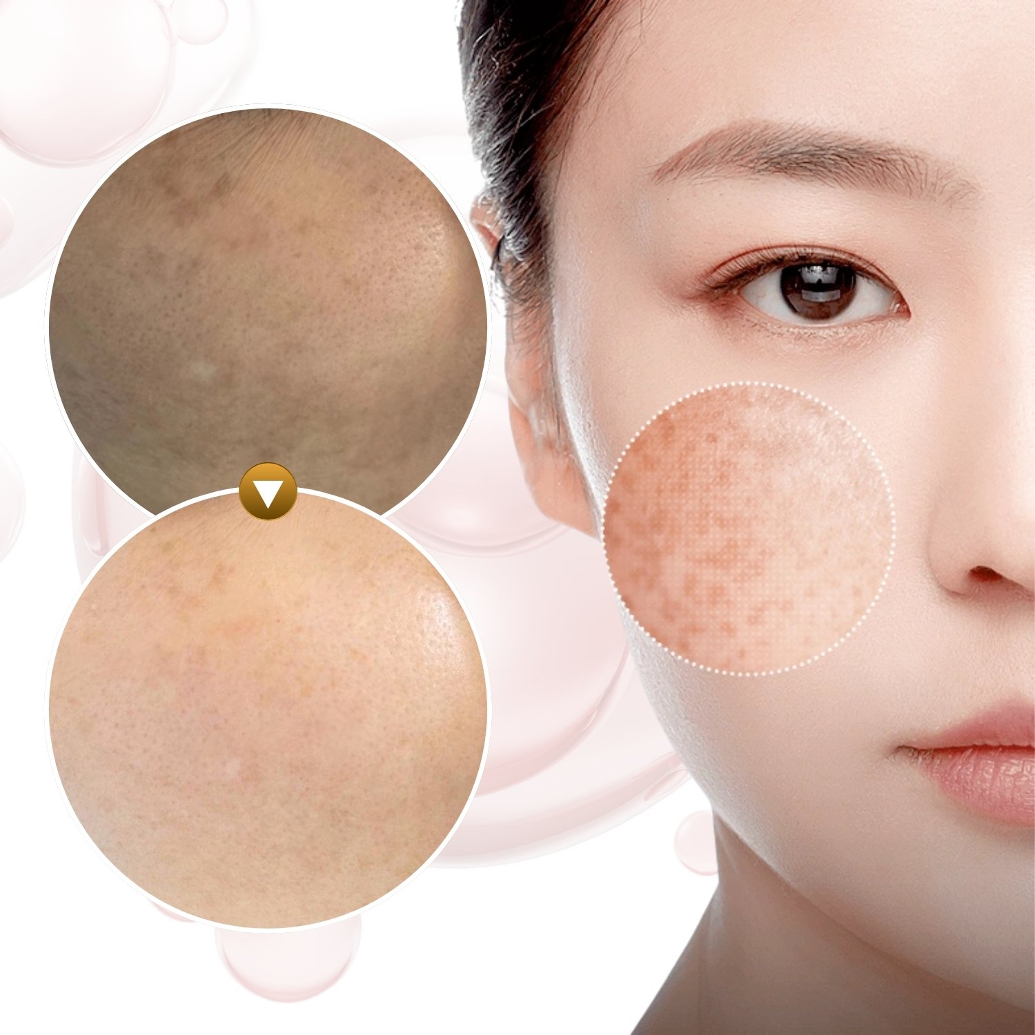 Nám và lão hóa da