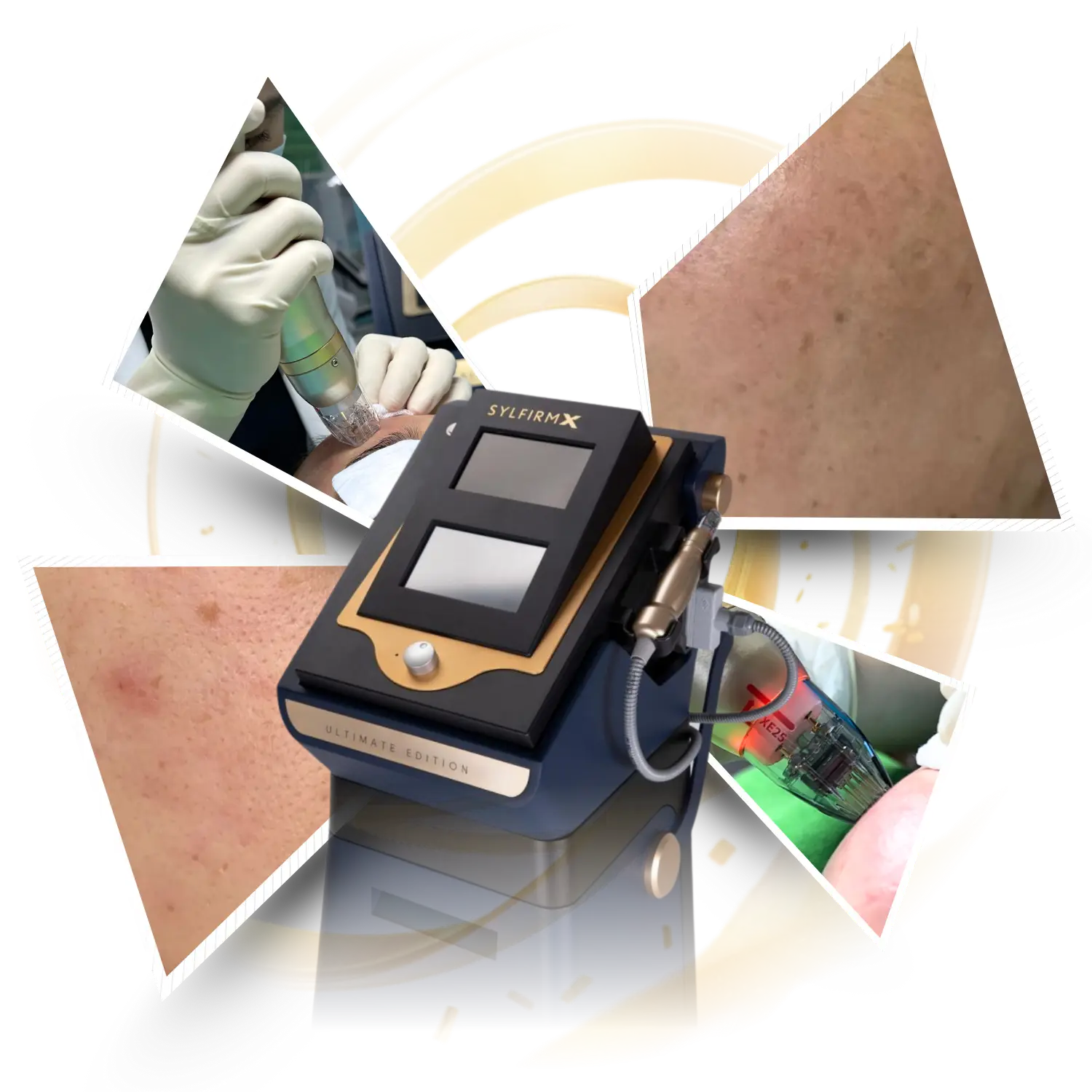 Vượt trội trong điều trị nám và trẻ hóa