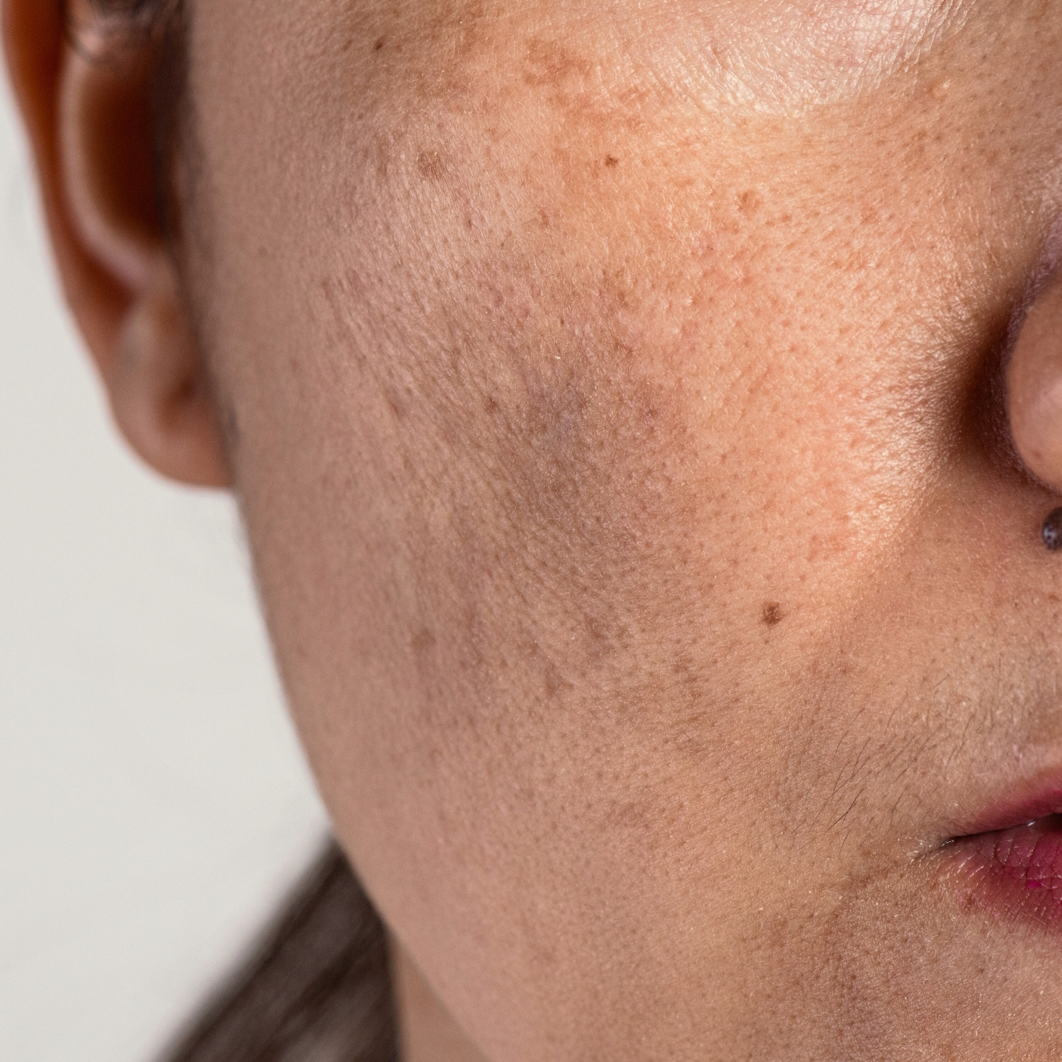 Điều trị sắc tố da