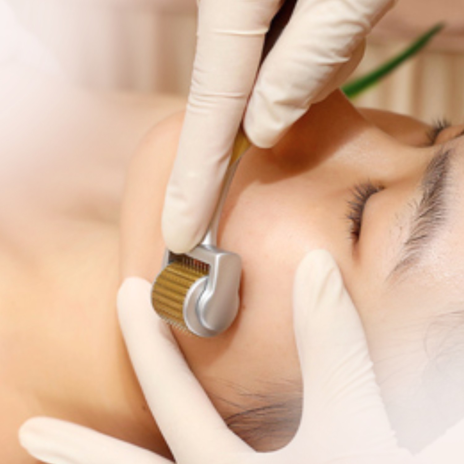 So với lăn kim truyền thống