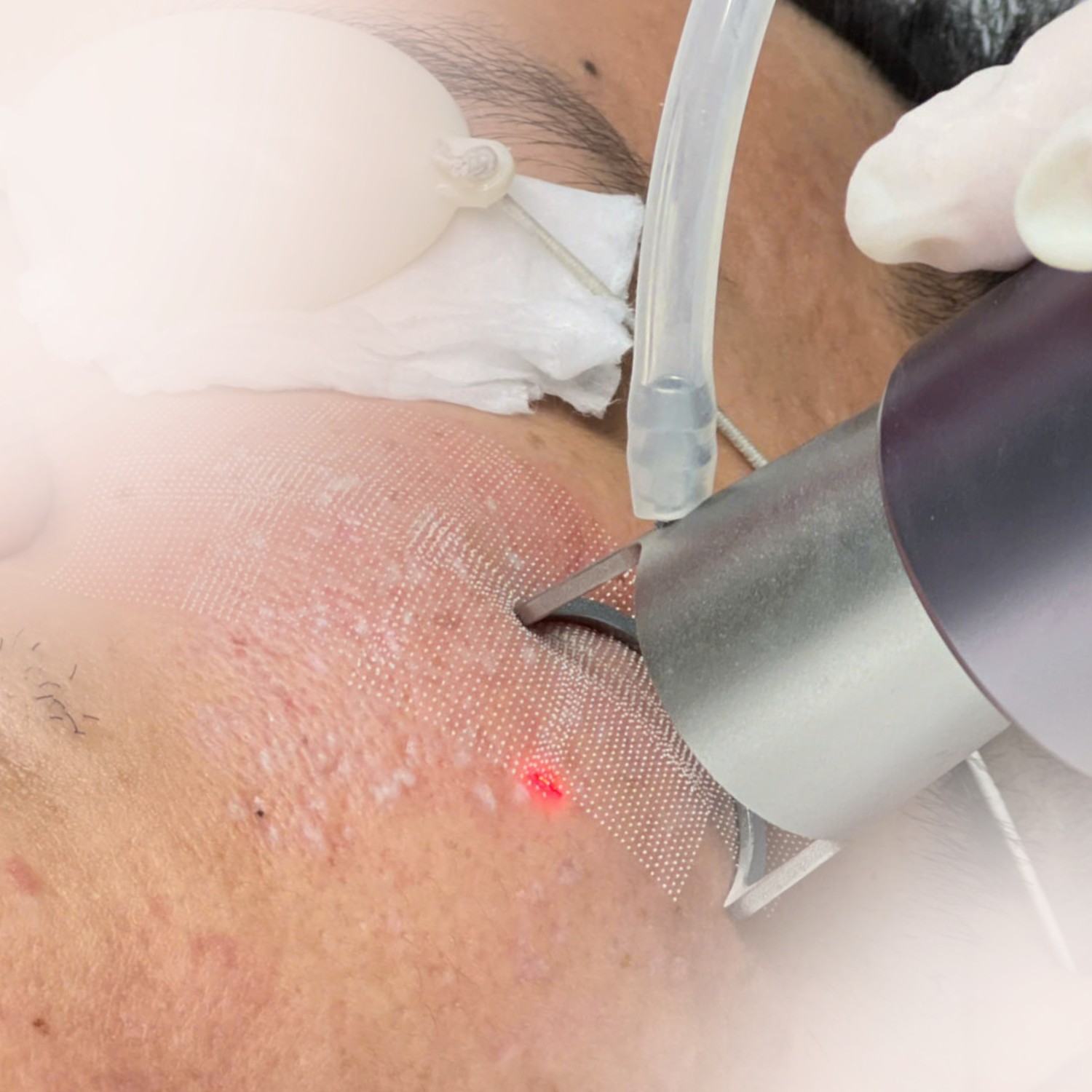 So với laser fractional