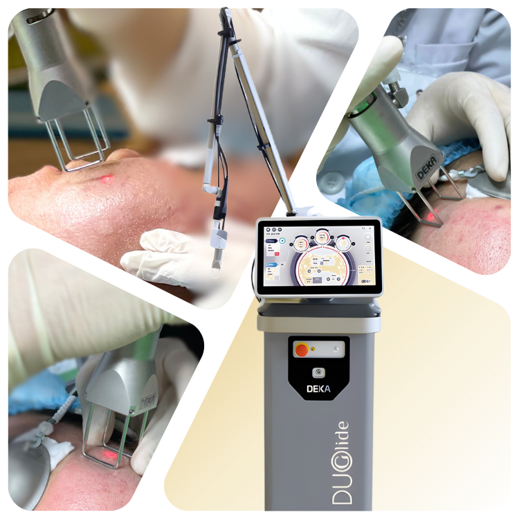Laser Deka Duoglide