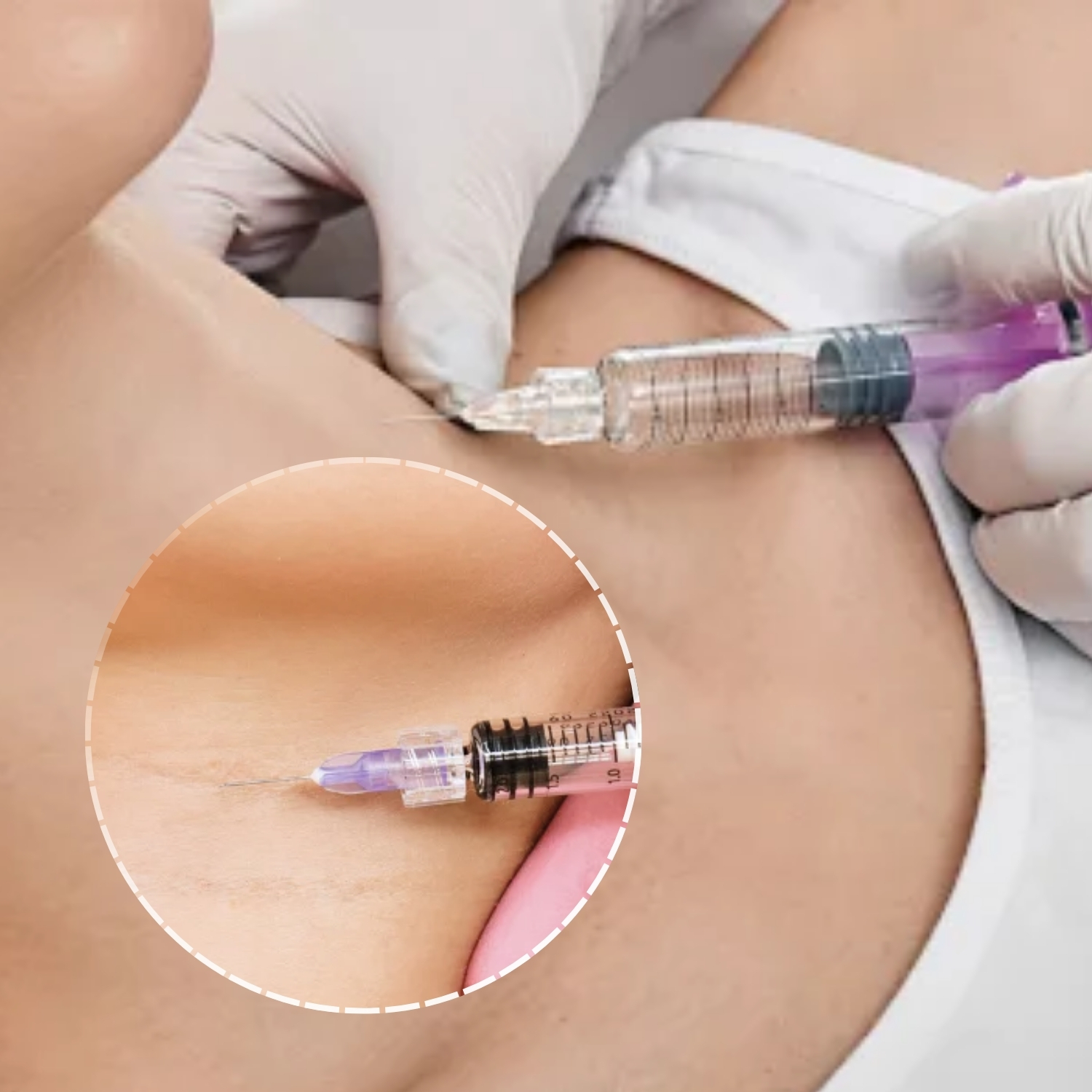 Nhiều vùng điều trị