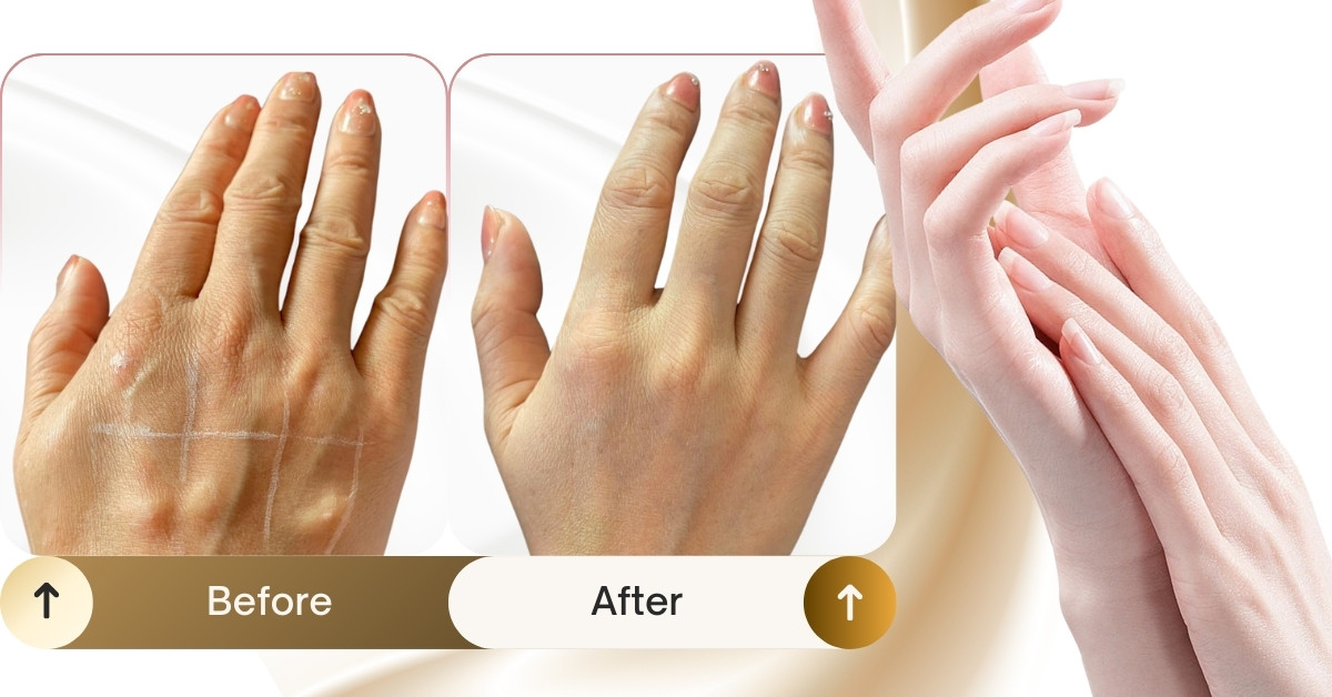 Trẻ hóa bàn tay