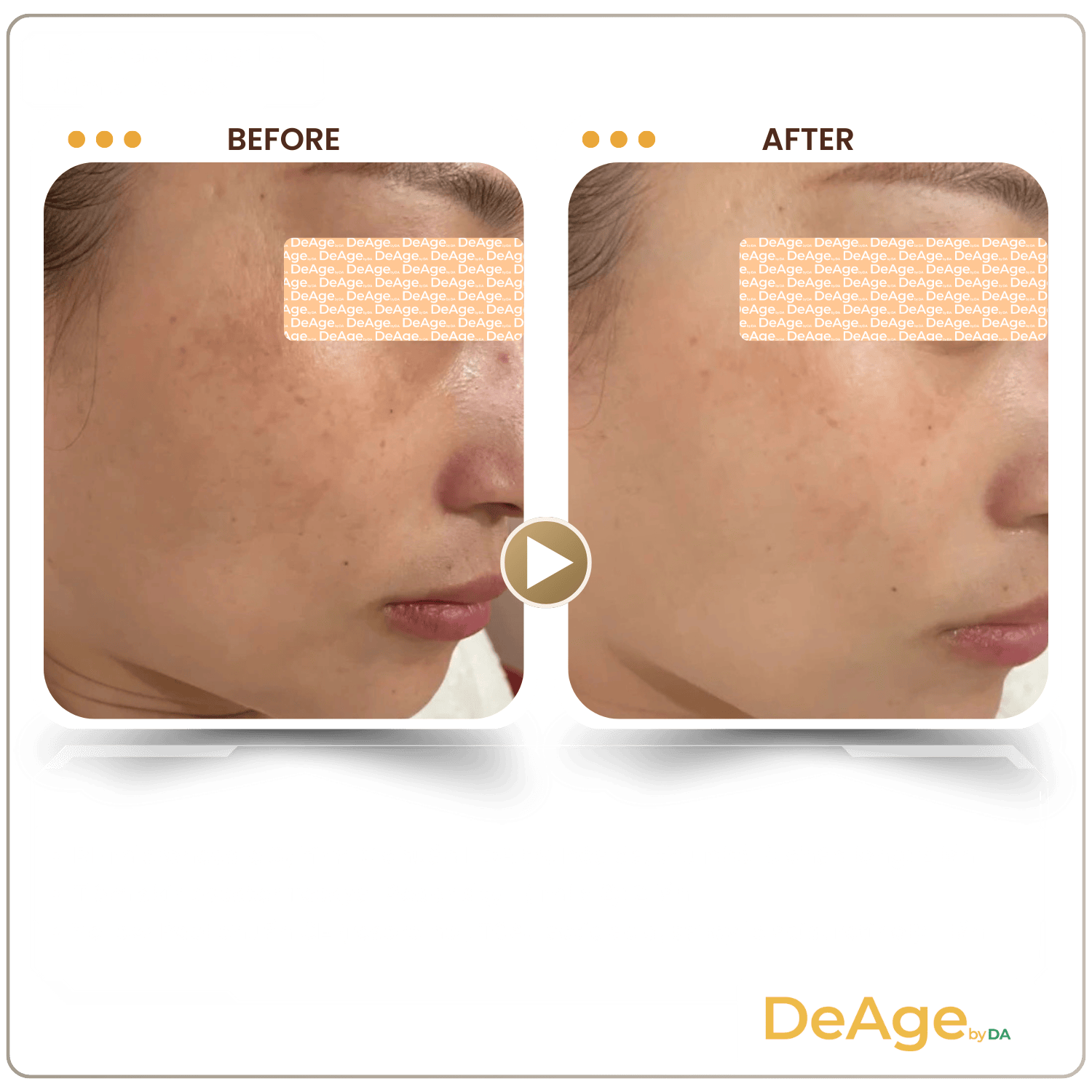 Mesotherapy 33