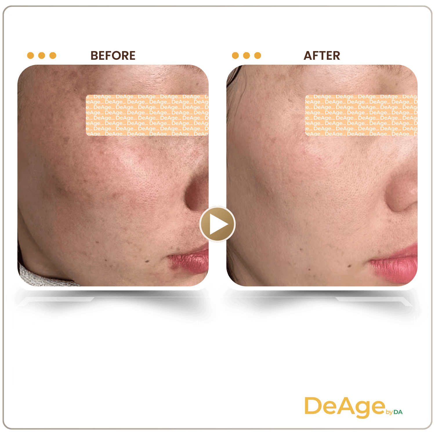 Mesotherapy 34