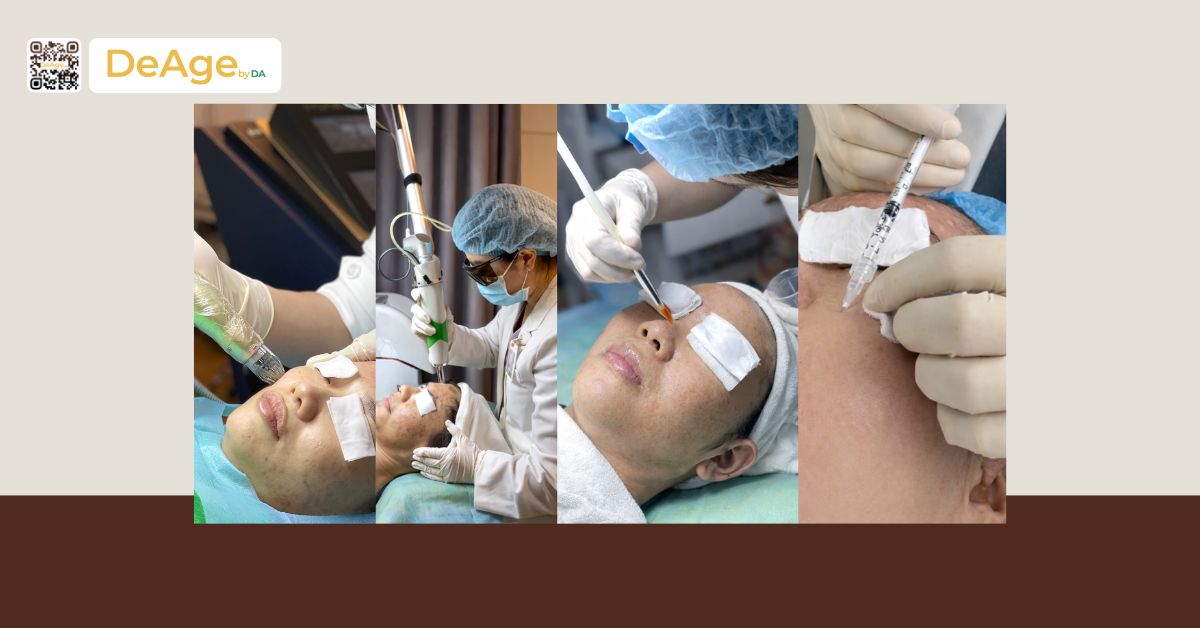 Nám da: nguyên nhân và cách xử lý an toàn để da sáng trở lại 7 4 liệu trình bài nám da