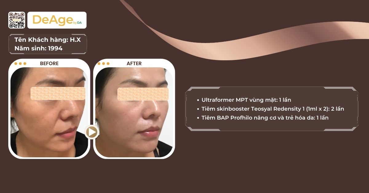 CFU và HIFU là gì? So sánh hiệu quả trong nâng cơ và trẻ hóa da 4 CLS HIFU