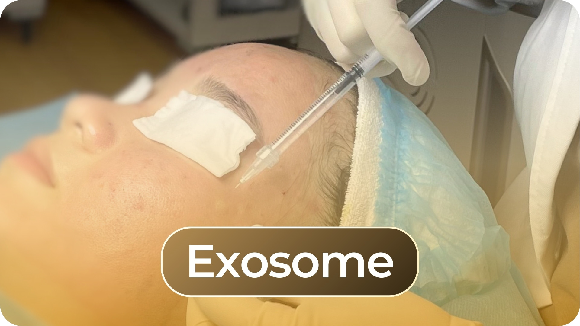 Exosome