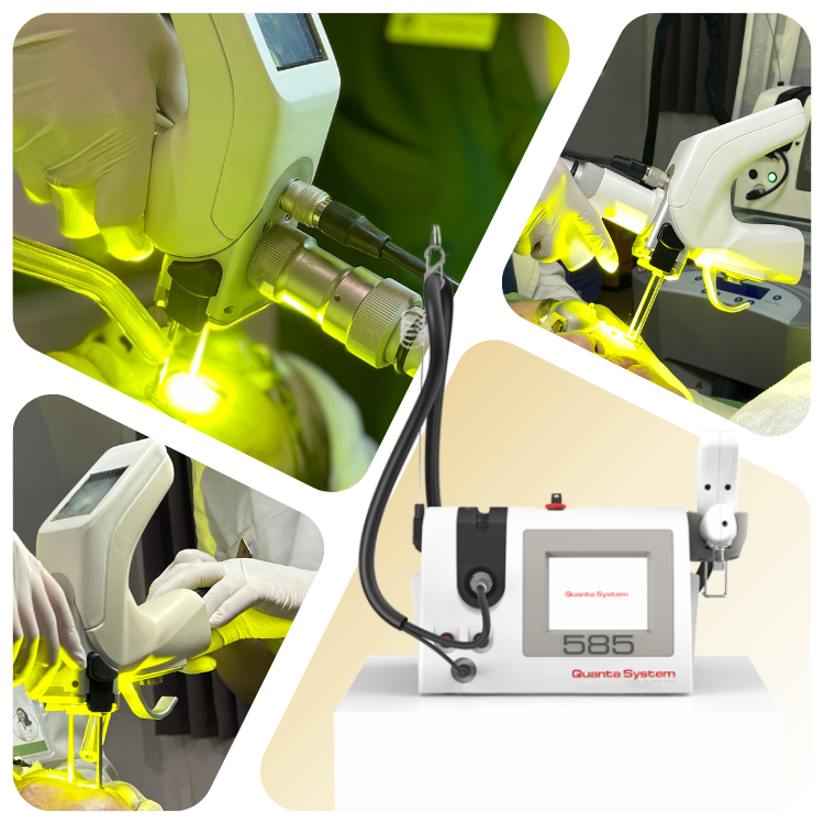 Laser Quanta 585 (1)