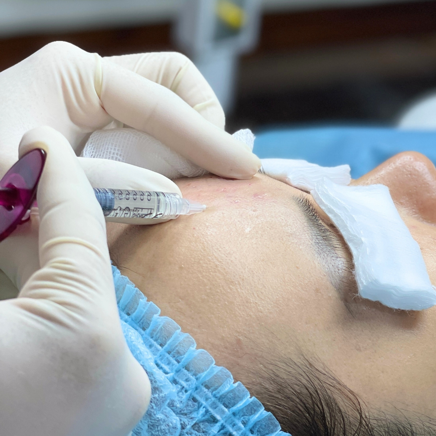 Mesotherapy (tiêm vi điểm)
