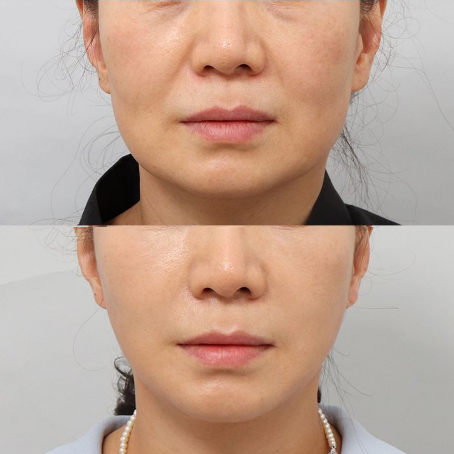 Tái lập sự cân xứng và hài hòa gương mặt