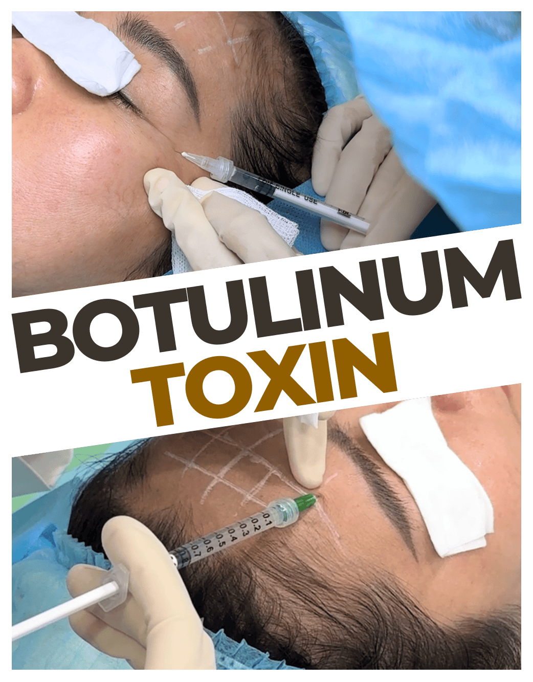 Ưu điểm của Botulinum toxin