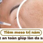Tiêm meso trị nám: bí quyết an toàn giúp làn da sáng mịn