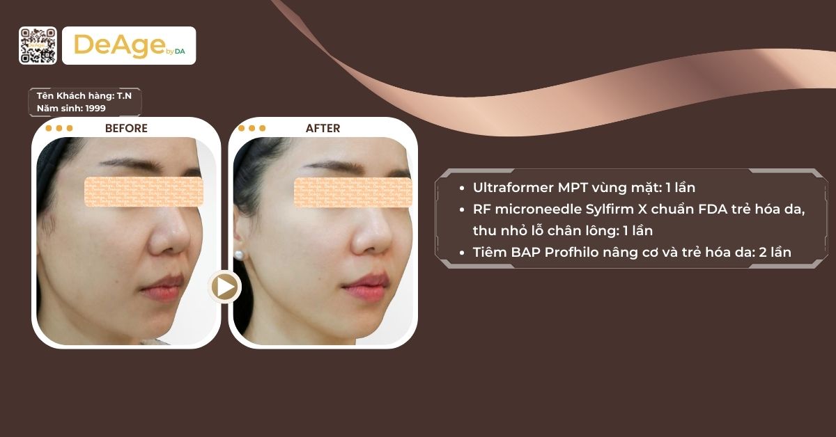 Máy HIFU: cơ chế hoạt động và hiệu quả trong nâng cơ trẻ hóa da 7 ca lâm sàng