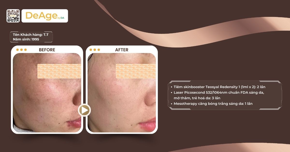 Nám da: nguyên nhân và cách xử lý an toàn để da sáng trở lại 9 ca lâm sàng điều trị nám