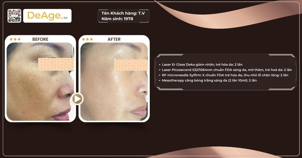 Tiêm meso căng bóng da: chi phí và hiệu quả thế nào? 2 ca lâm sàng meso căng bóng