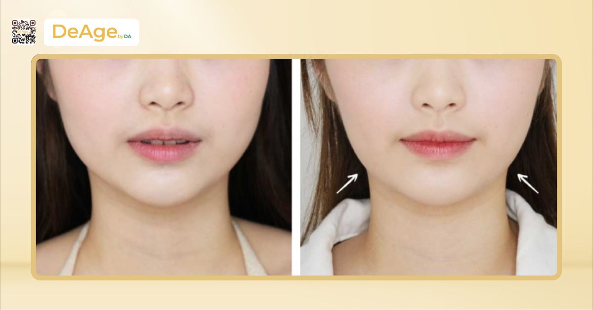 Những tác hại tiêm botox thon gọn mặt và cách giảm thiểu nguy cơ 6 ca lâm sàng tiêm botox thon gọn mặt