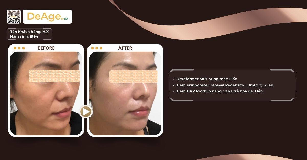 Nên tiêm meso bao lâu 1 lần để trẻ hóa da an toàn và hiệu quả? 1 ca lâm sàng tiêm meso 1