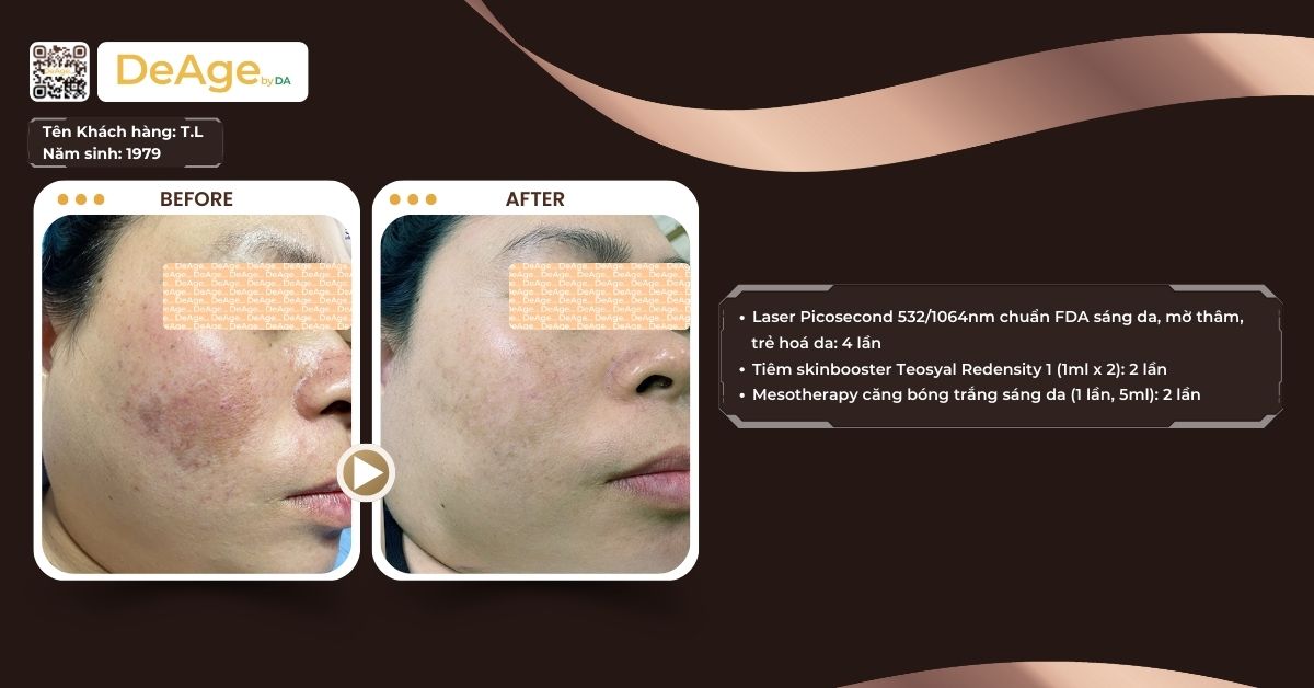 Nên tiêm meso bao lâu 1 lần để trẻ hóa da an toàn và hiệu quả? 2 ca lâm sàng tiêm meso 2