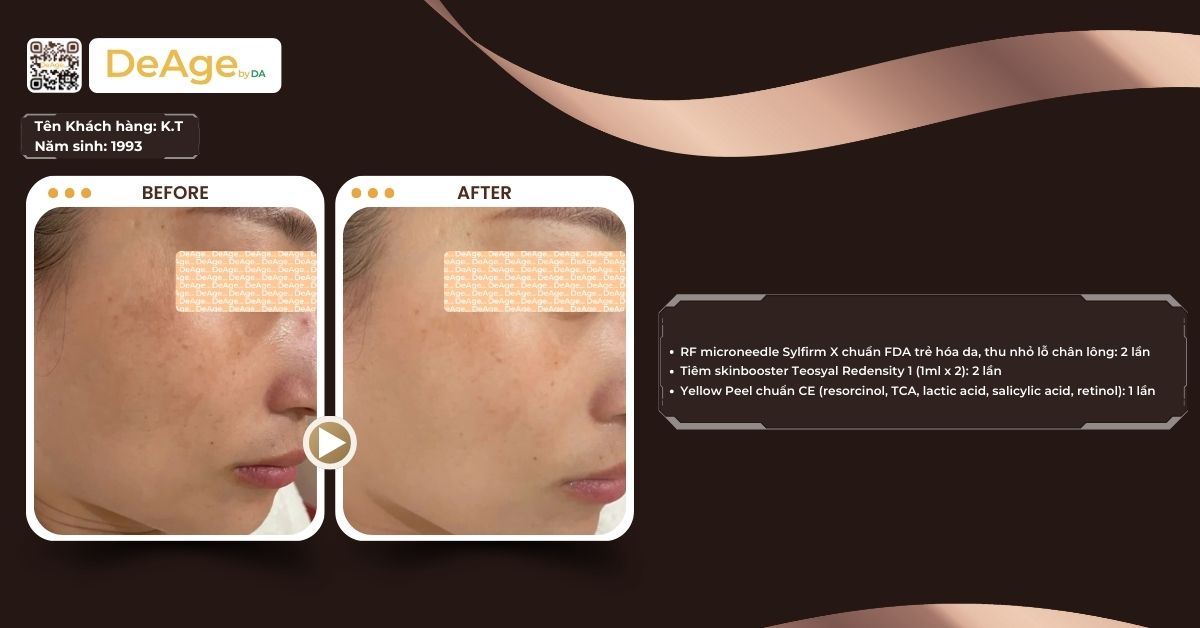 Tác hại của tiêm meso khi điều trị sai cách 3 ca lâm sàng tiêm meso thành công