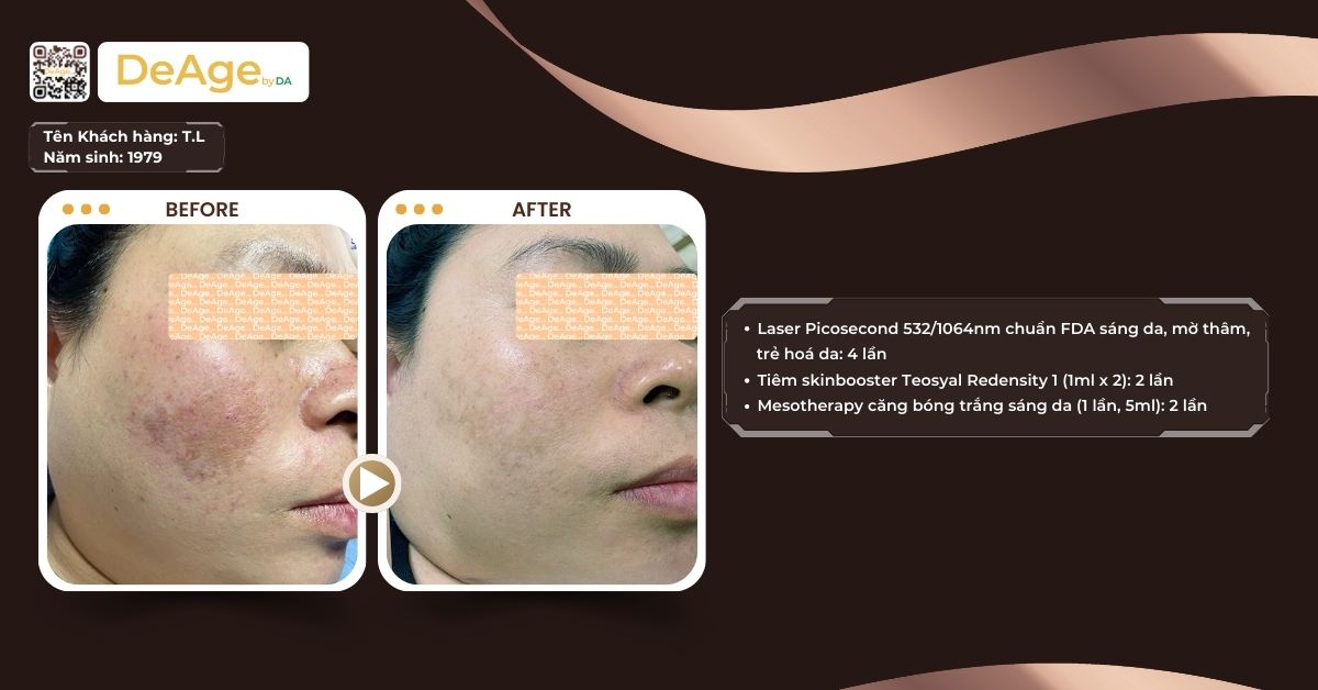 Hướng dẫn chăm sóc da sau tiêm meso giúp da phục hồi nhanh và rạng rỡ 4 ca lâm sàng tiêm meso