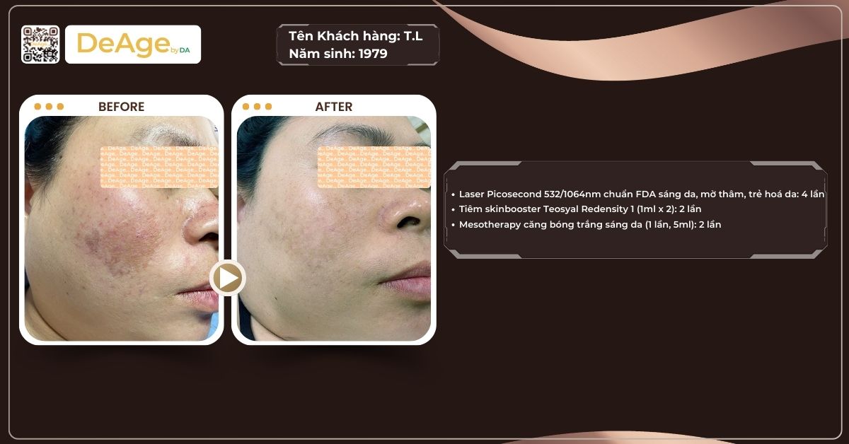 Vitamin C trị nám có thật sự hiệu quả không và dùng sao cho đúng? 5 ca lâm sàng