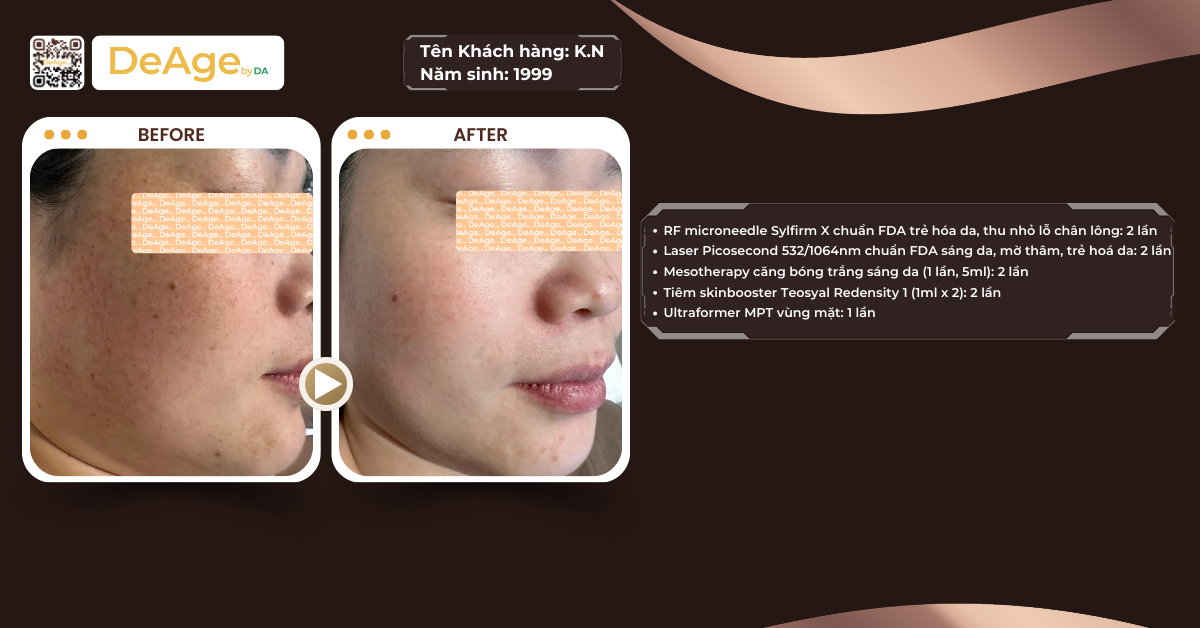 Các loại nám da phổ biến và cách nhận biết đúng để trị hiệu quả 4 ca lâm sàng