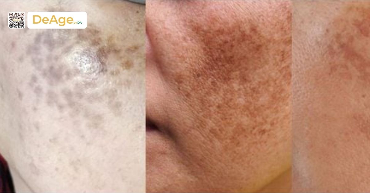 Da bị nám nhẹ có tự hết không? Hướng dẫn chăm sóc và trị đúng cách 2 các loại nám