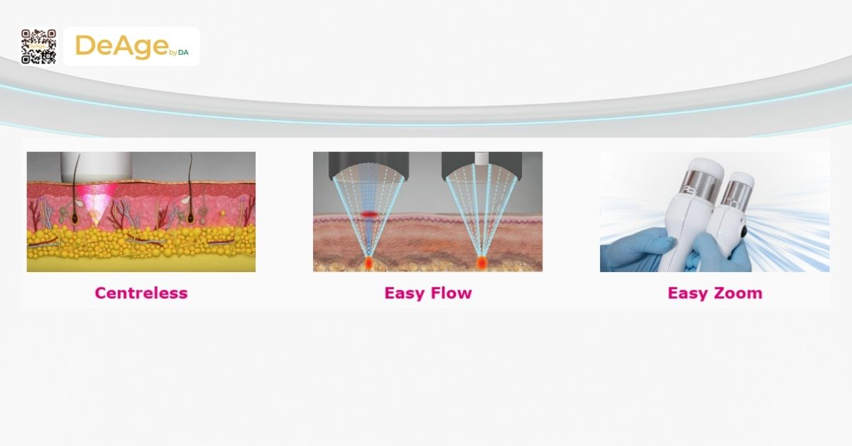Máy HIFU: cơ chế hoạt động và hiệu quả trong nâng cơ trẻ hóa da 6 centreless, easy flow, easy zoom