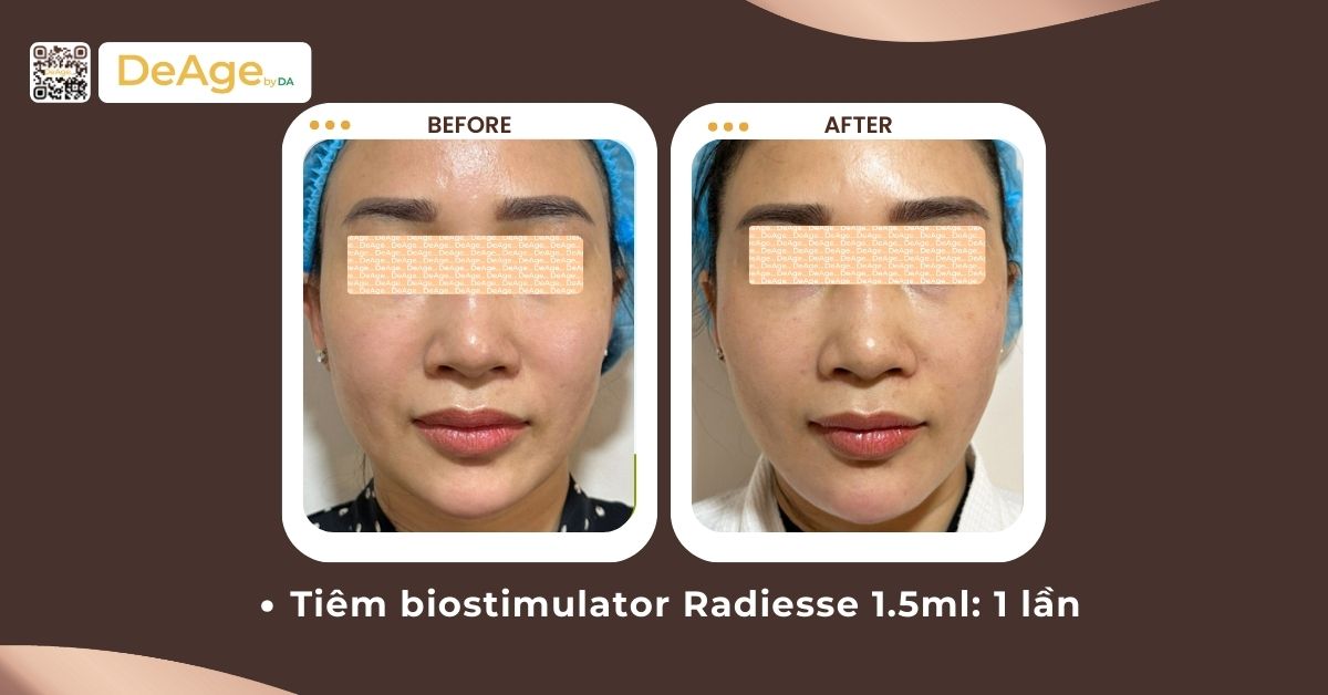 Nên chọn filler, bột chỉ, CaHA hay PMMA để tăng thể tích gương mặt? 6 cls tiêm radiesse