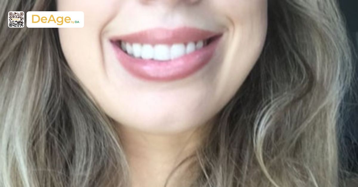 Những tác hại tiêm botox thon gọn mặt và cách giảm thiểu nguy cơ 2 cười lệch