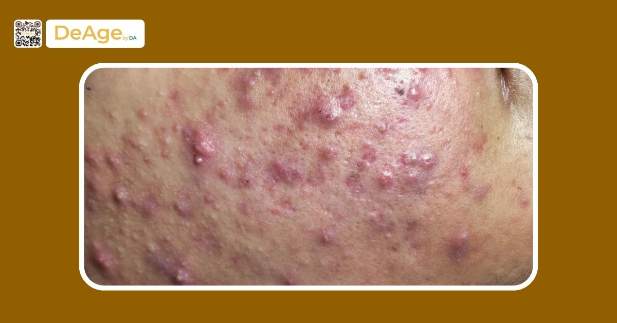 Tiêm meso trị nám: bí quyết an toàn giúp làn da sáng mịn 6 Tiêm meso trị nám: bí quyết an toàn giúp làn da sáng mịn 5