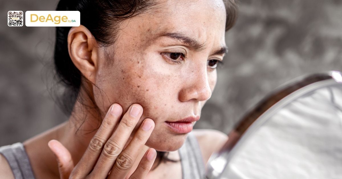 Tiêm meso trị nám: bí quyết an toàn giúp làn da sáng mịn 2 da khô
