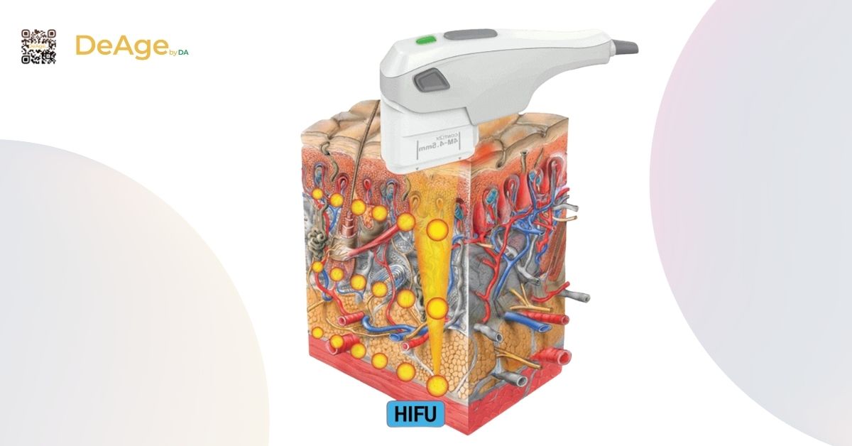 CFU và HIFU là gì? So sánh hiệu quả trong nâng cơ và trẻ hóa da 1 hIFU