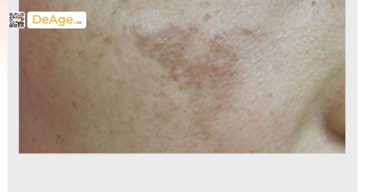 Da bị nám nhẹ có tự hết không? Hướng dẫn chăm sóc và trị đúng cách 1 hình nám mảng