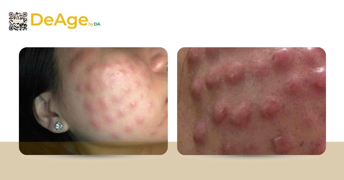 Tiêm meso giá bao nhiêu? Đừng vội quyết định chỉ dựa vào giá 4 hình u hạt