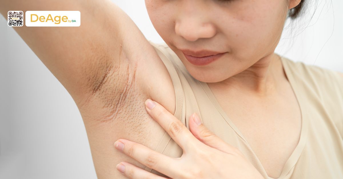 Tiêm botox trị hôi nách giá bao nhiêu? Ai phù hợp và nên thực hiện ở đâu? 1 hôi nách