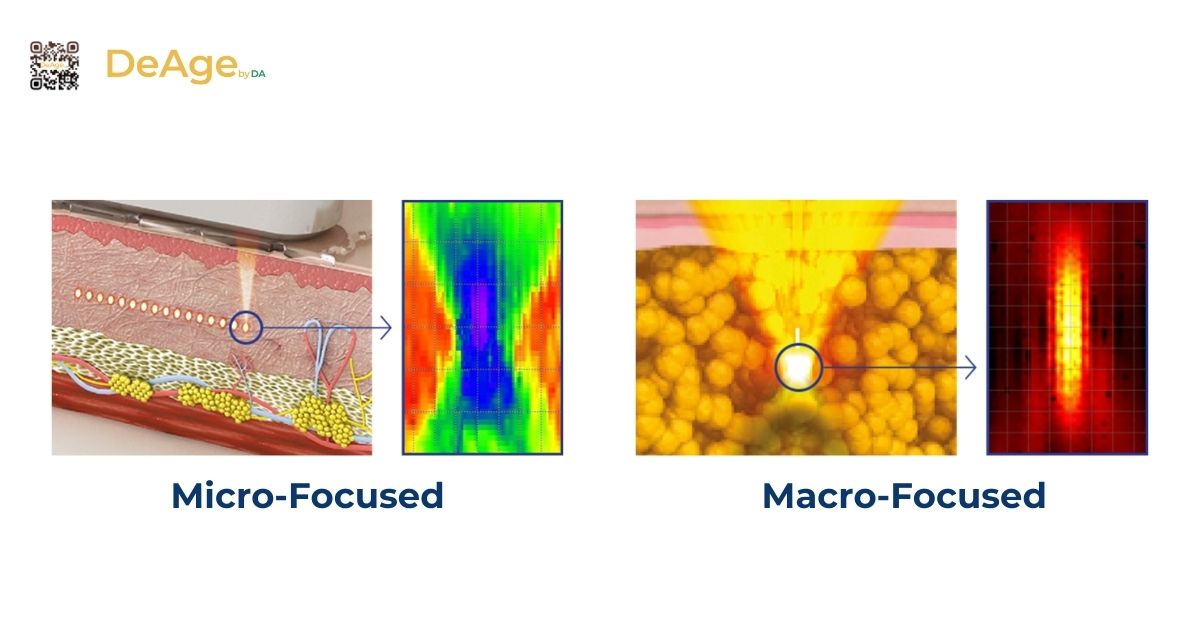 Máy HIFU: cơ chế hoạt động và hiệu quả trong nâng cơ trẻ hóa da 4 micro focused và macro focused