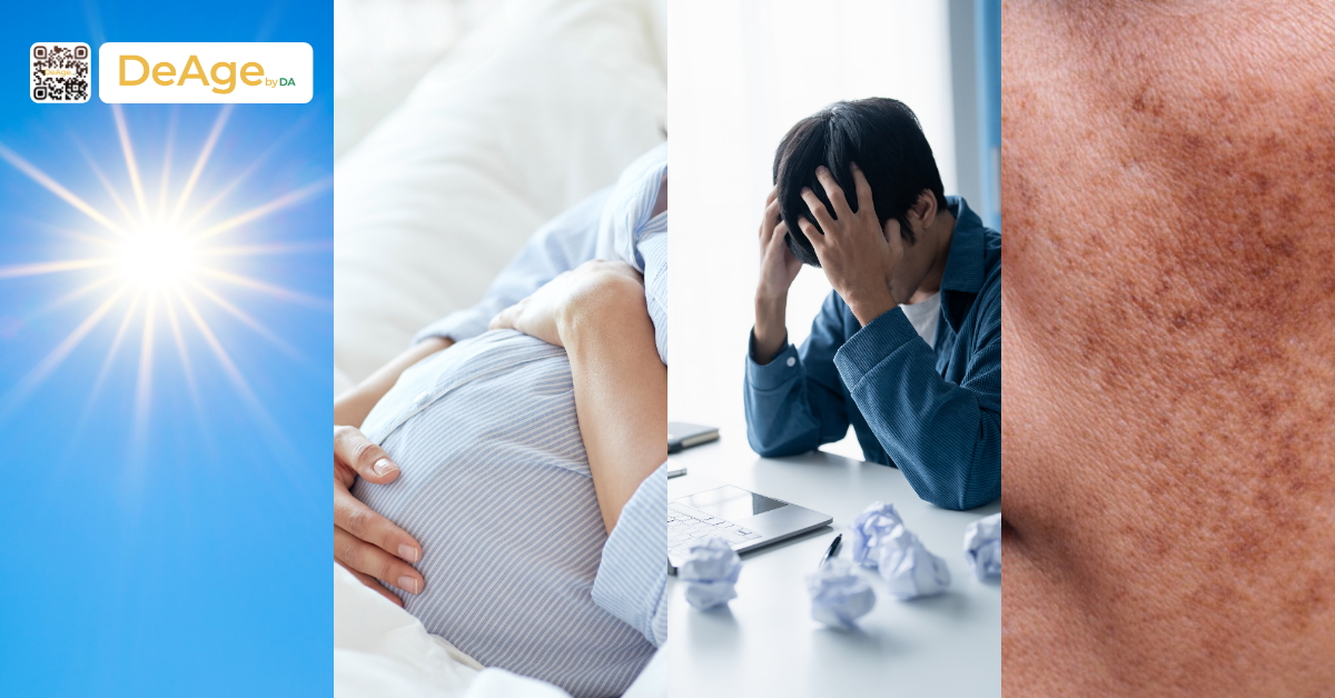 Các loại nám da phổ biến và cách nhận biết đúng để trị hiệu quả 2 nguyên nhân nám da