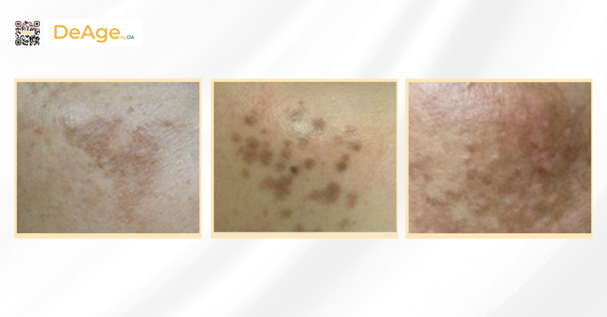 Các loại nám da phổ biến và cách nhận biết đúng để trị hiệu quả 1 phân loại nám da