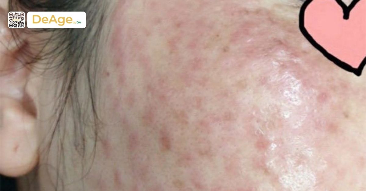 Tiêm meso trị nám: bí quyết an toàn giúp làn da sáng mịn 4 tác hại tiêm meso sai cách