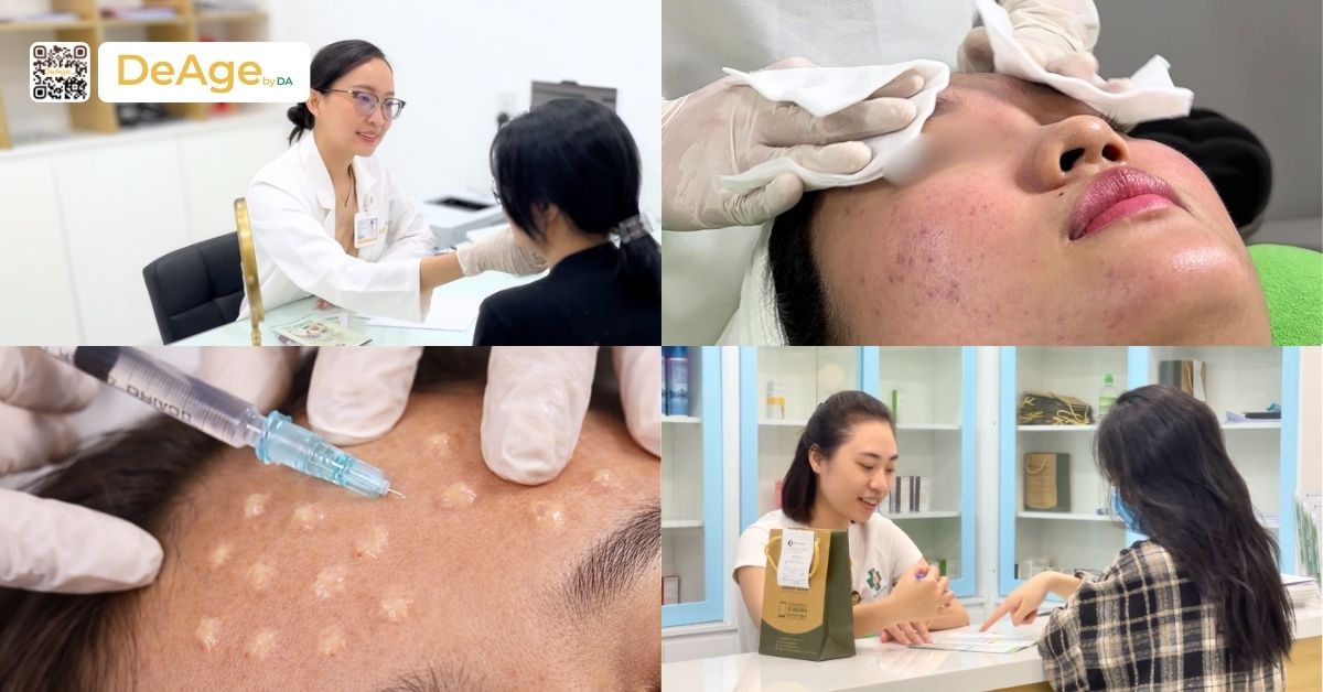 Tiêm meso căng bóng da: chi phí và hiệu quả thế nào? 4 tiêm meso căng bóng