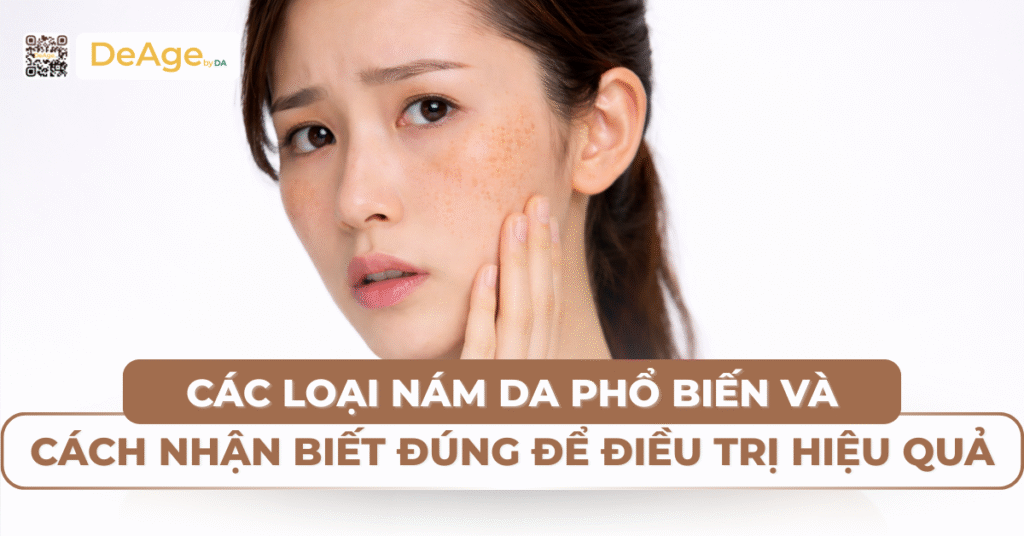 Các loại nám da phổ biến và cách nhận biết đúng để trị hiệu quả 10 tiêu đề