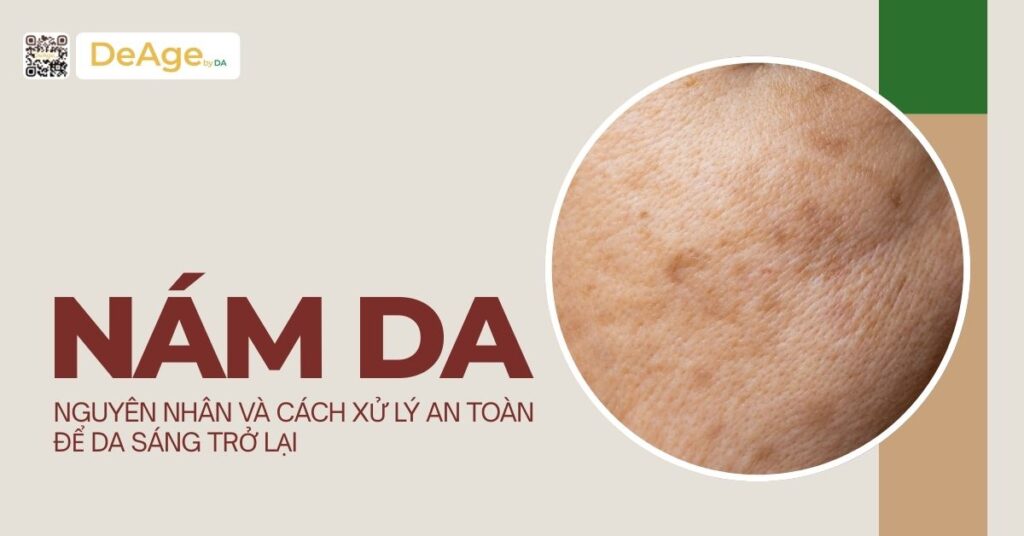 Nám da: nguyên nhân và cách xử lý an toàn để da sáng trở lại 8 tiêu đề nám da nguyên nhân và cách xử lý