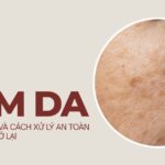 Nám da: nguyên nhân và cách xử lý an toàn để da sáng trở lại