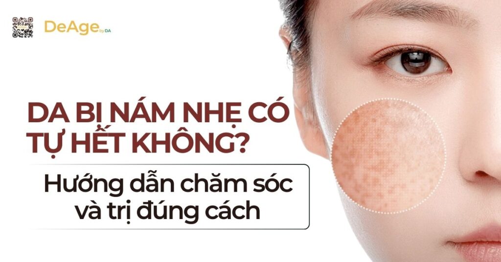 Da bị nám nhẹ có tự hết không? Hướng dẫn chăm sóc và trị đúng cách 9 tiêu đề nám nhẹ có tự hết k