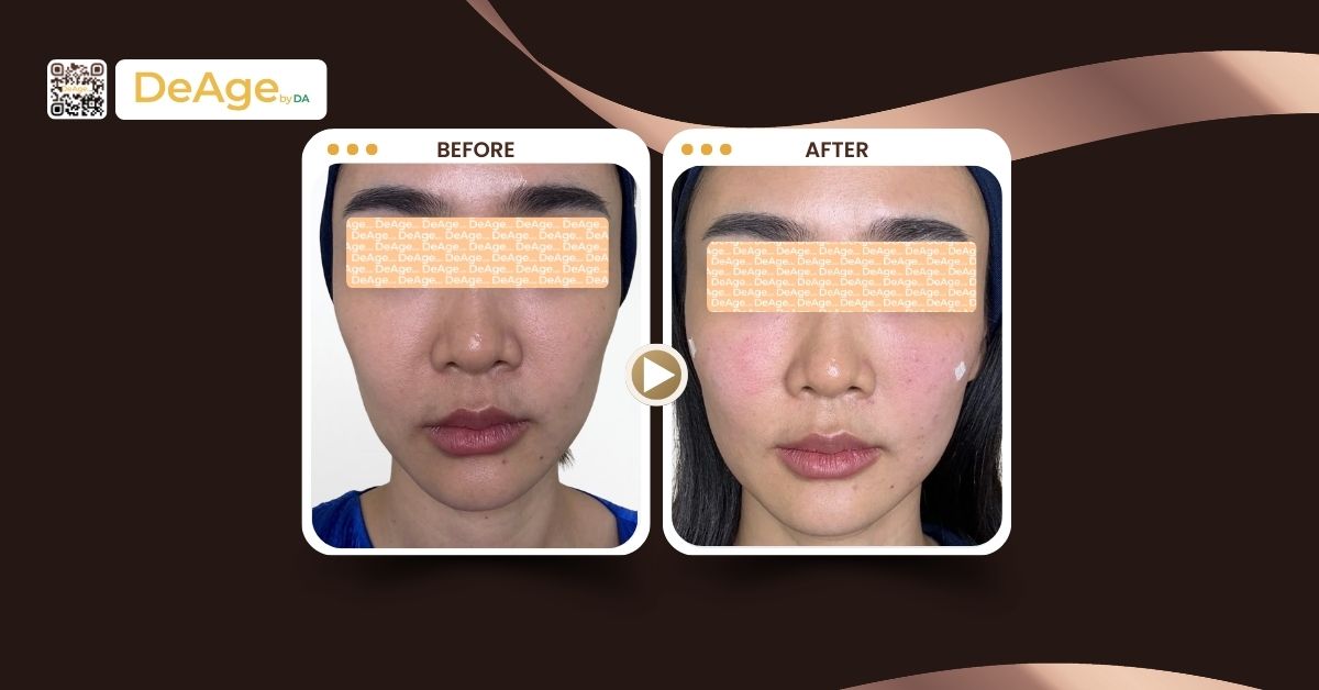 Lenisna: chất kích thích sinh học chứa PDLLA giúp làm đầy và trẻ hóa 7 JUVELOOK